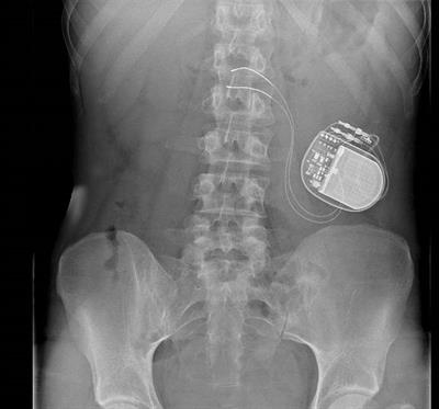 Gastric Electrical Stimulation: Role and Clinical Impact on Chronic Nausea and Vomiting